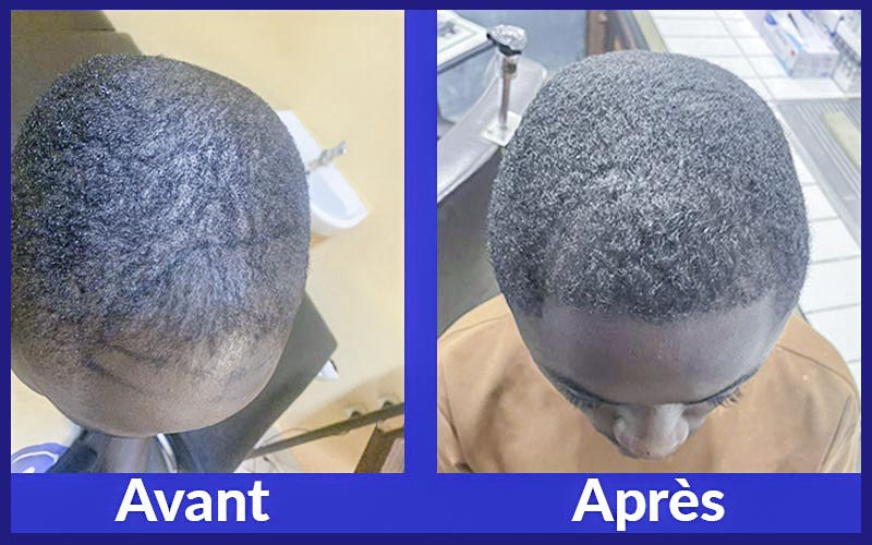 Implantation capillaire